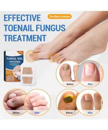Roser 32 Piece Toenail Correction Patch | Nail Repair & Strengthening for Damaged & Discolored Nails - Buy Online on GoSupps.com