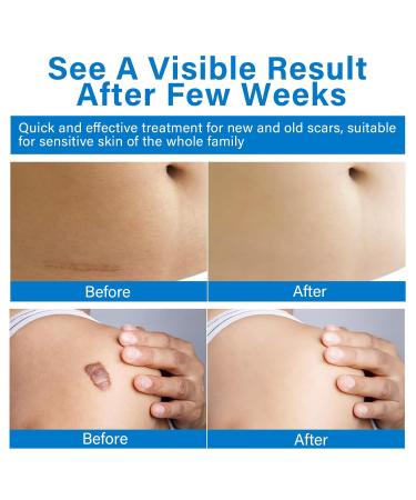Silicon Scar Gel for Keloid & Piercing Bump Removal - 0.7 Oz - Buy Online on GoSupps.com
