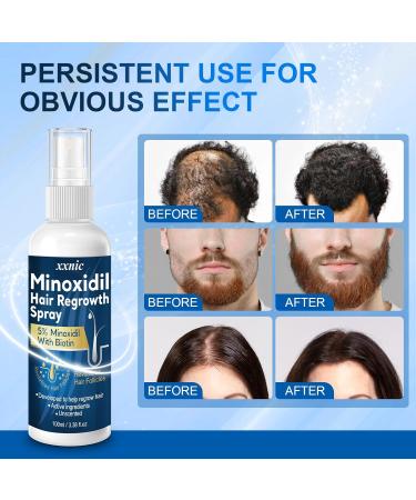 5% Minoxidil Hair Growth Serum - Effective Hair Loss Treatment for Men & Women 100ML | Combat Thinning Hair & Promote Regrowth - Buy Online on GoSupps.com