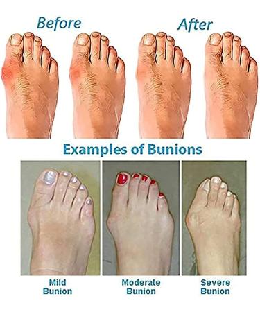 Orthopedic Women's Bunion Correction Sandals - Arch Support, Open Toe, Flat Sole - Buy Online on GoSupps.com