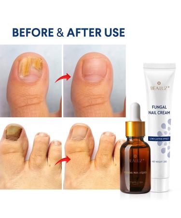 Fungal Nail Treatment Kit - Stop Fungus & Restore Healthy Toenails - Buy Online on GoSupps.com
