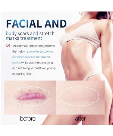 Soothing Scar Removal Cream for Body, Stretch Marks & Tan - Light Blue (One Size) - Buy Online on GoSupps.com