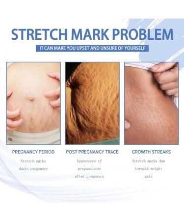 Stretch Strip Repair Cream for Women - Advanced Stretch Mark Removal | Professional Post-Birth Skin Care - Buy Online on GoSupps.com