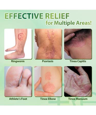 Cr me antifongique pour la mycose de l aine et du pied: Traitement Naturel contre le Pied d Athl te les D mangeaisons du Jock la Teigne et l Ecz ma 30g 30 g (Lot de 1) - Buy Online on GoSupps.com