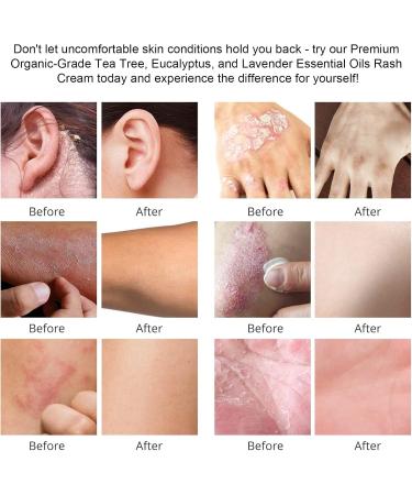 Itchy Feet Relief Cream - Soothing Treatment for Jock Itch Athlete's Foot Psoriasis & More | 4.00 Fl Oz - Adults & Kids - Buy Online on GoSupps.com