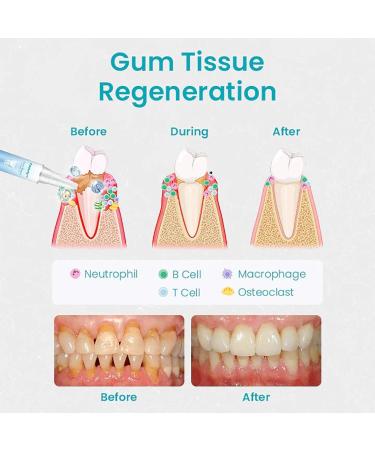 Taileden Gum Therapy Gel Taileden Gum Therapy Gel for Recessed Gums Taileden Gum Care Gel Gum Shield Therapy Gel Gum Therapy Gel Teeth Whitening Essence Pen (2PCS) - Buy Online on GoSupps.com