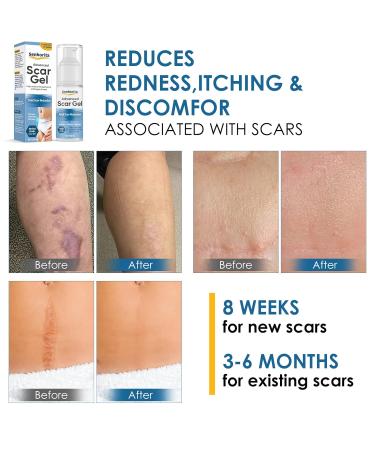 Advanced Scar Cream Gel - Effective Scar Treatment for Face & Body | Remove Surgical Scars C-Section Stretch Marks Acne & More - Buy Online on GoSupps.com