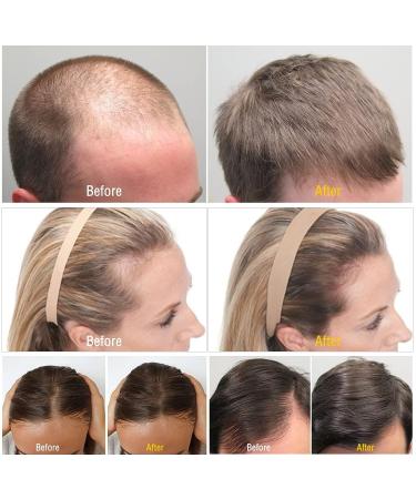 5% Minoxidil Derma Roller Kit for Hair Growth w/ Serum Oil - Biotin Treatment - Men Women - 0.25mm - Buy Online on GoSupps.com