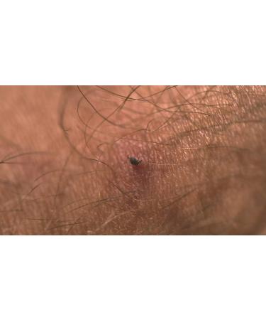 Lifesystems Tick Removal Card - Essential Tool for Outdoor Safety | Shop Now for Global Shipping - Buy Online on GoSupps.com