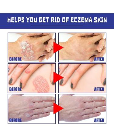 HEKEWER South Moon Psoriasis Repair Spray - Professional Herbal Treatment for Skin Plaque Psoriasis - Buy Online on GoSupps.com