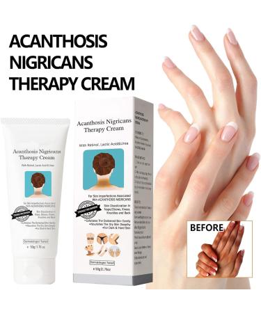 Dark Knuckles Whitening Serum 50g Acanthosis Nigricans Therapy Cream Dark Spot Corrector Cream Dark Spot Remover for Underarms Knees Elbows Inner Thigh - Buy Online on GoSupps.com