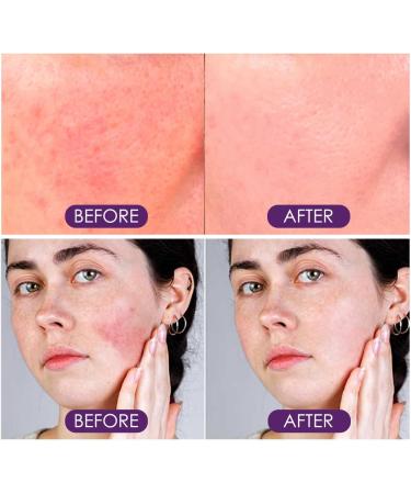 Soothing & Barrier Support Serum Face Serum for Women Face Moisturiser Hydrating&Brightening Serum Skincare Serum Relieves Dry/Tight/Reddened Skin Anti Aging Serum for Face Dark Spot Remover for Face - Buy Online on GoSupps.com