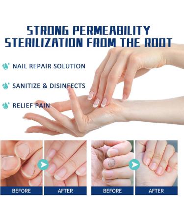 Fungal Nail Serum Pen with Tea Tree Oil and Aloe - Extra Strong Treatment for Toenails and Fingernails - Improve Damaged Nails - 1PCS - Buy Online on GoSupps.com