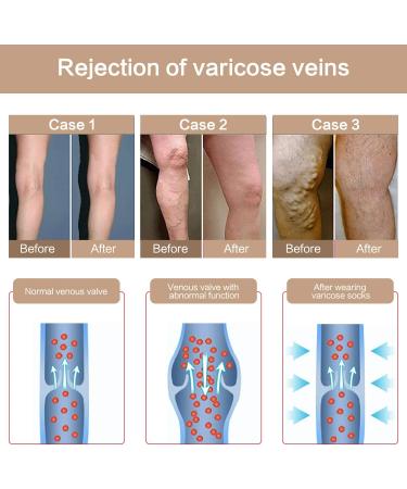 Women's 20-30 mmHg Compression Pantyhose 2 Pairs - Support Stockings for Varicose Veins - Large Size, Closed Toe - Buy Online on GoSupps.com
