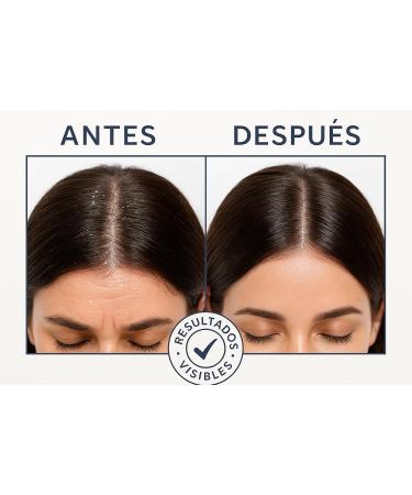 Shampoing Anti-Chute 1000 ml Professionnel Cheveux Fins Fortifiant Cuir Chevelu Densit & Vitalit Chute Saisonni re/Androg n tique - Buy Online on GoSupps.com