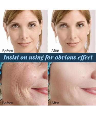 YNFS Profirm Korean Soluble Protein Thread Soluble Protein Thread Lifting Instant Face Protein Thread Absorbable Collagen Thread for Face Lift Reduce Fine Lines Wrinkle Firming Skin (180Pcs) - Buy Online on GoSupps.com