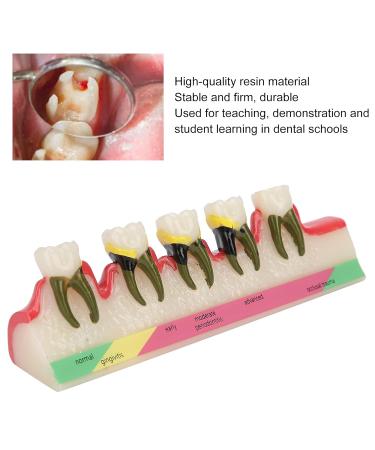 Dental Periodontal Disease Model Tooth Disease Study Teaching Model for Dental School - Buy Online on GoSupps.com