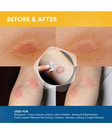 OHEAL Fast-Acting Ringworm Treatment Cream | Antifungal Cream for Tinea Versicolor, Athlete's Foot & Jock Itch | 2oz 56g - Buy Online on GoSupps.com