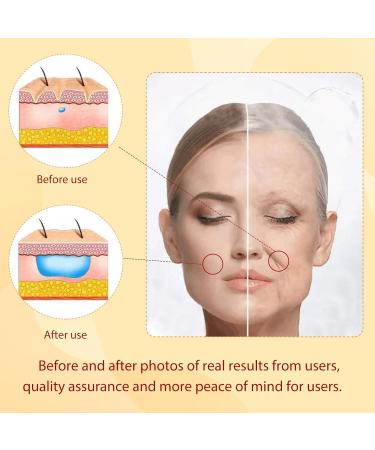 Minovd PDO Gearwheel Thread - 360r Bidirectional Tooth Wheel for V-Face Lift 18g 100mm 20 Pieces - Effective Skin Tightening Solution - Buy Online on GoSupps.com