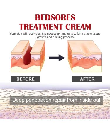  JPSDOWS Anti-Decubitus Cream | Anti-Decubitus Care 20g Healing Cream for Raping Pain Relief for Irritated Skin Difficult to Heal Skin - Relief Jpsdows - Buy Online on GoSupps.com