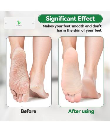 Nano Glass Foot File Callus Remover - Best Foot Care Pedicure Tool for Soft Feet - Travel-friendly Foot Scrubber for Men and Women (White) - Buy Online on GoSupps.com