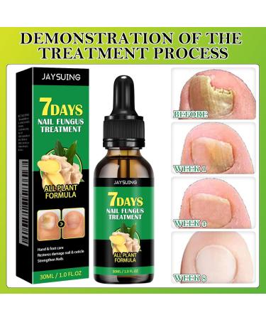 KERANEET Ginger Nail Care Nail Care Nail Repair Ginger Cuticle Care Oil for fragile nails protection to strengthen the nail treatment nail care ginger - Buy Online on GoSupps.com