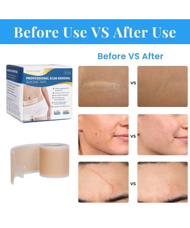 Professional Silicone Scar Sheets Roll - 60 x 1.6 Inches | Reusable Treatment for Keloid, C-Section, Surgery & Acne Scars - Buy Online on GoSupps.com