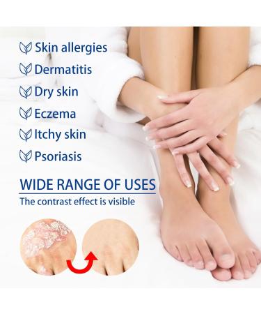 FRTG Dermatitis and eczema cream itching and irritated skin suitable for dry skin eczema and psoriasis caring cream for dry and sensitive skin 1 - Buy Online on GoSupps.com