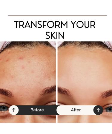 10% Azelaic Acid Cream - Acne Treatment Redness Relief & Skin Soothing | 1.7 fl oz (50ml - Buy Online on GoSupps.com