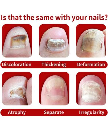 Quick Relief Oil Fungal Nail Treatment Rapid Relief Oil Nail Fungus Treatment For Toenail Nail Treatment Oil Toe Nail Fungal Treatment Onychomycosis Nail Treatment Toenail Repair for Damaged Nails - Buy Online on GoSupps.com
