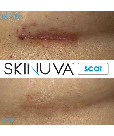 Skinuva Complete Care System - Hyperpigmentation & Scar Treatment with Bruise Relief - 1 oz Cream, 0.5 oz Next Gen Scar Cream, 14 Capsules - Buy Online on GoSupps.com