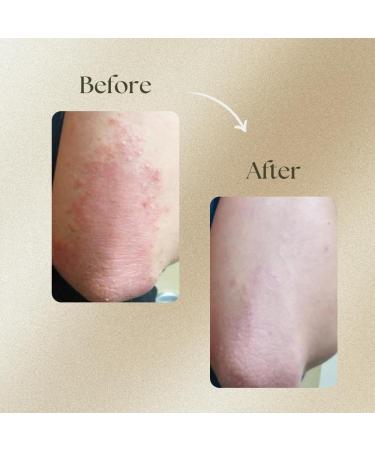 kk Cream for Dry Itchy & Flaky Skin | with Neem and Turmeric for All Types of Psoriasis | Smoothens The Skin | 50g - Buy Online on GoSupps.com