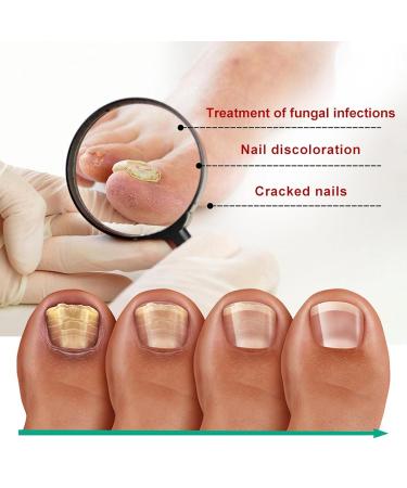 Nail Repair Essence for Fingernail & Toenail Fungus - Repairs, Protects, and Strengthens Nails (3 Pcs) - Buy Online on GoSupps.com
