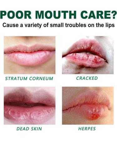 Mouth Ulcer Treatment Spray Mouth Ulcer Treatment for Adults Canker Sore Treatment Oral Care Spray Herbal Mouth Spray Canker Sores Relief Spray for Mouth Ulcer Bad Breath Treatment Mouth Freshener - Buy Online on GoSupps.com