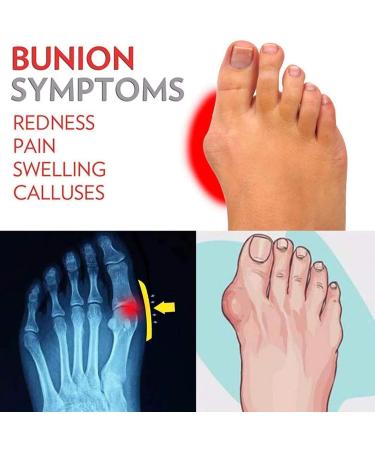 Comfortable Bale Toilet Sandals for Men | Hallux Valgus Relief | Bunion Pain Shoes | Size 38 EU - Blue - Buy Online on GoSupps.com