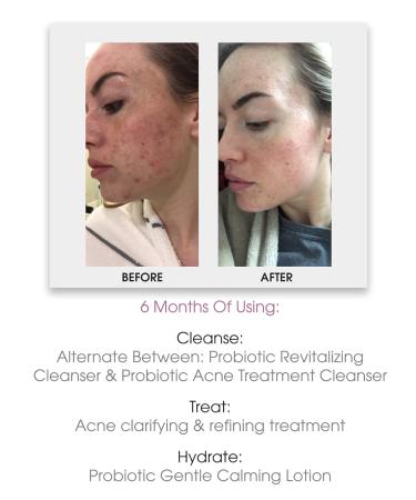Glowbiotics Acne Clarifying Treatment | Probiotic Acne Control Gel with Salicylic Acid | Minimizes Breakouts & Unclogs Pores | 1 Fl Oz - Shop Now - Buy Online on GoSupps.com