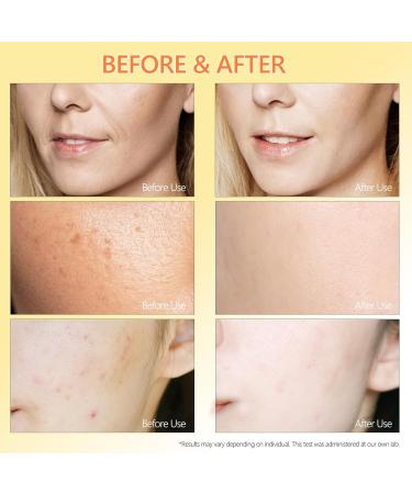 Pure 4% Niacinamide Serum for Acne Treatment for Face & Dark Spots | Brightening Face Serum with 1.5% Vitamin C | 1% Hyaluronic Acid | 1% Ceramide T5 | Made in China (4 fl.oz/120ml) Travel Pack Size - Buy Online on GoSupps.com