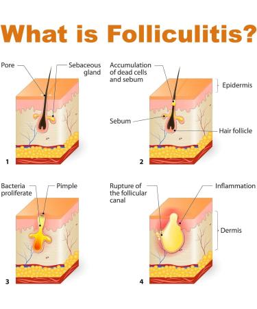 RedOceansM Acne grease and acne cream antipimple gel 20 g acne cream suitable for most skin types - Buy Online on GoSupps.com