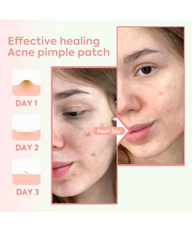 AINA Hydrocolloid Pimple Patches - Invisible Acne Spot Dots | Clear Natural Zit Patches | 48 Dots + Bonus Chin & Nose Patches - Buy Online on GoSupps.com