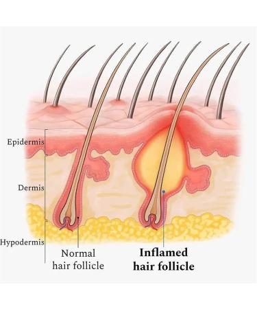 Natural Scalp Therapy Hair Oil Scalp Folliculitis Relief Therapy Nourishing Scalp Oil Balancing Oils Protect Scalp Health - Buy Online on GoSupps.com