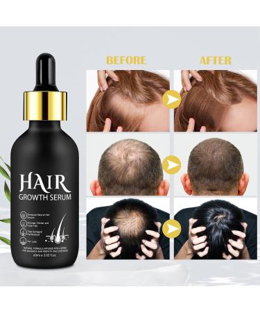 5% Minoxidil Hair Growth Serum - Biotin Oil for Men & Women | Thicker Healthier Hair Regrowth Treatment 2.02 oz - Buy Online on GoSupps.com