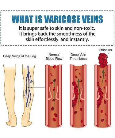 Varicose Veins Treatment Cream Raura Varicose Veins Treatment Cream Raura Varicose Veins Cream Cream for Varicose Veins Ointment for Varicose Veins Varicose Veins Cream (5pcs) - Buy Online on GoSupps.com