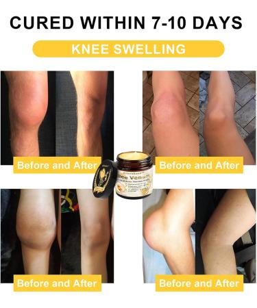 ArthroEase Bee Venom Joint and Bone Cream ArthroEase Bee Venom Cream Bee Venom Joint Gel Effectively Relieve Joint discomfort (2) - Buy Online on GoSupps.com