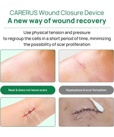 5pcs Zip Stitch Suture Free Wound Closure Strips | Butterfly Bandages for Emergency Laceration Repair - First Aid Kit Essential - Buy Online on GoSupps.com