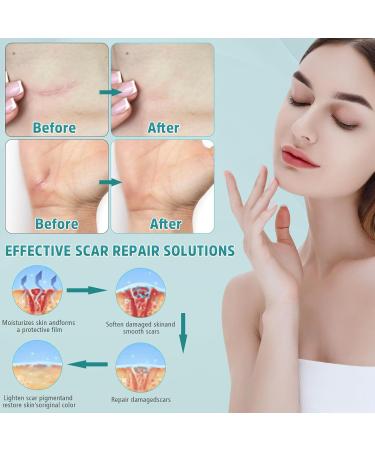 Advanced Scar Cream - Professional Silicone Gel for Surgical Stretch Marks & Old/New Scars (50ml) - Effective Scar Removal Solution - Buy Online on GoSupps.com