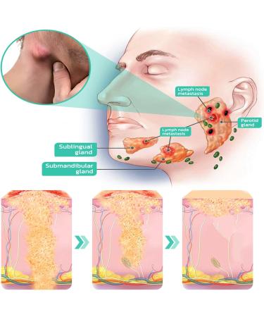  DUBUSH Gfouk Lymph Node Treatment Roll Cream Lymph Node Treatment Roll Cream Neck Firming Cream Neck Swelling - Buy Online on GoSupps.com