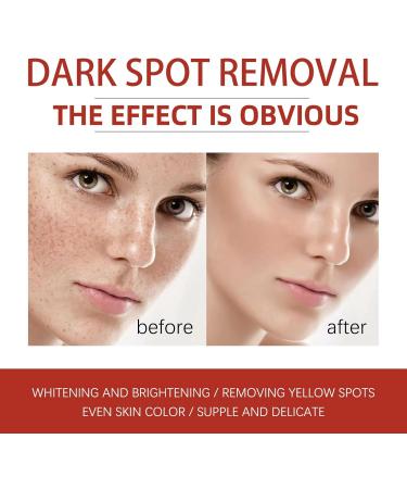 Kojic Acid Cream Dark Spot Remover for Face Skin Lightening Cream for Anti Aging Dark Spot Correcting Glow Serum Face Moisturizer for Women Pigmentation Removal Cream Freckle Removal Cream Dark Spots - Buy Online on GoSupps.com