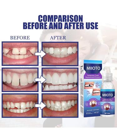 Buy Temporary Tooth Repair Kit | Dental Adhesive Set & Formable False Teeth for Quick Fixes - Buy Online on GoSupps.com