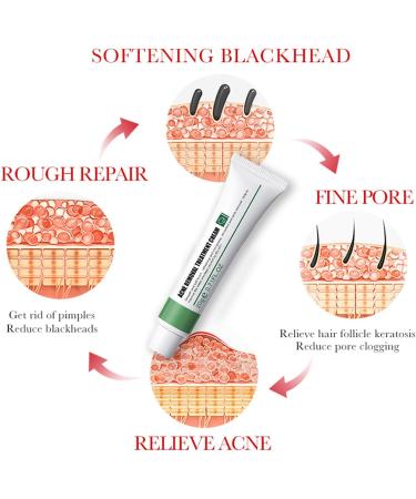 Anti Acne Cream for Acne Treatment and Spot Treatment with Nicotinamide Sodium Hyaluronate Aloe for Acne Prone & Sensitive Skin Reduce Redness Moisturiser Fade Acne Marks Oil Control - Buy Online on GoSupps.com