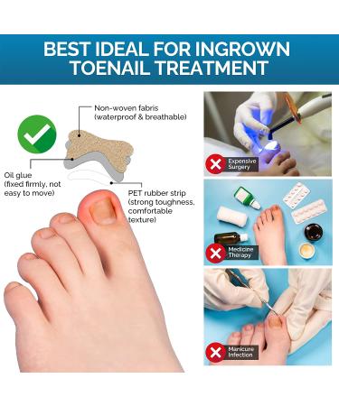 Ingrown Toenail Corrector Treatment Patch - 50 Pcs | Glue-Free Pedicure Tool - Buy Online on GoSupps.com